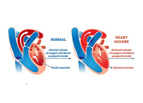 what is lvsd heart failure.